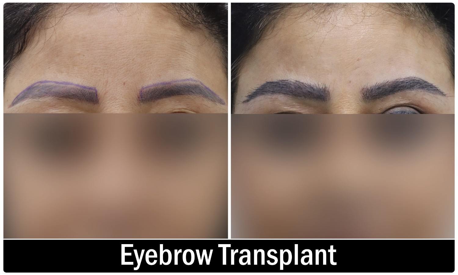 Facial hair transplant consultation at Symmetrica, Siliguri